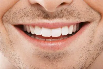 closeup of a patient's teeth after dental crowns helped restore his smile