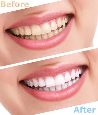 before and after teeth whitening services at Ouellette Family Dentistry